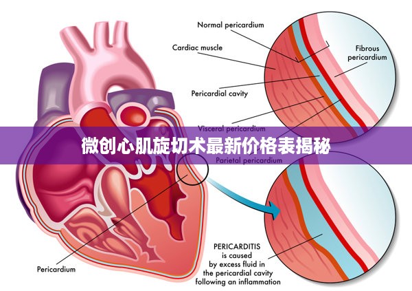 微创心肌旋切术最新价格表揭秘